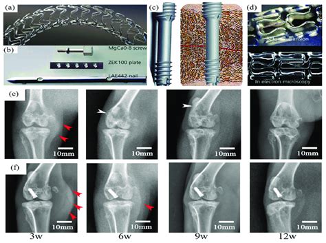  Zincalloy:  A Revolutionary Alloy for Orthopedic Implants and Biodegradable Stents!